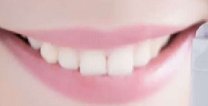 審美⻭科の治療について